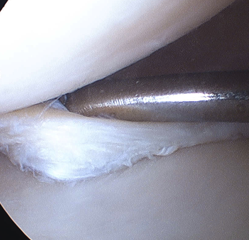 Meniscal Tear Posterior Horn